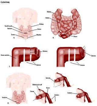 Affordable Laparoscopic Cystectomy Surgery in India | Low Cost Laparoscopic Cystectomy Surgery ...