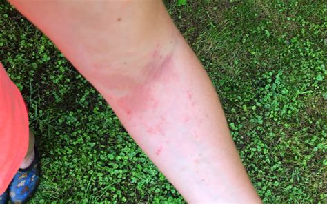 5 Natural Remedies for Poison Ivy Rashes - Allegheny Kiski Health Foundation