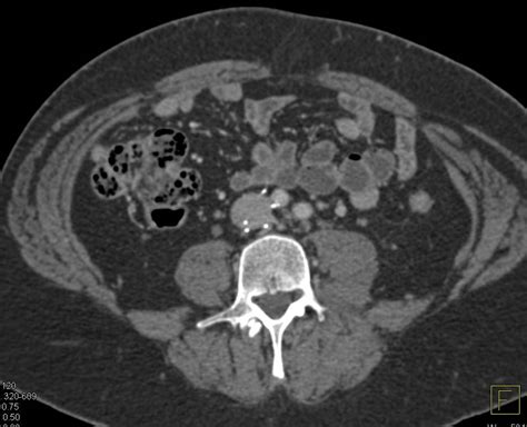 Malpositioned IVC Filter - Vascular Case Studies - CTisus CT Scanning