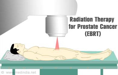 External Beam Radiation Therapy for Prostate Cancer