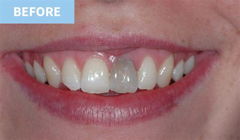 Teeth Whitening | Murray Dental Omagh