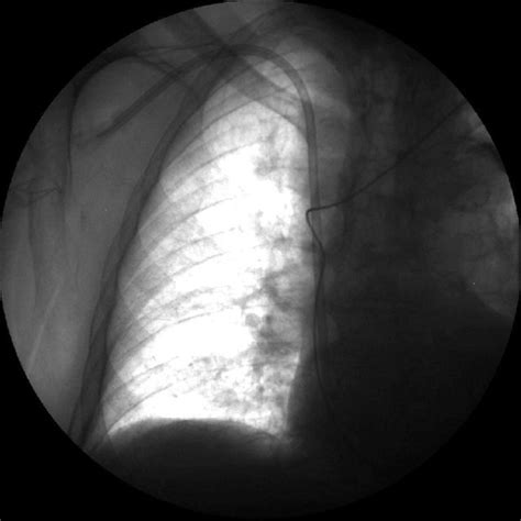 e Chest radiograph shows right sided tunnelled dialysis catheter... | Download Scientific Diagram