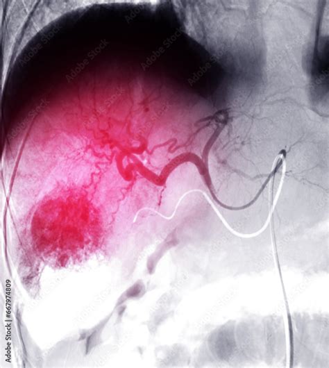 Transarterial Chemoembolization (TACE) is a medical procedure used to the treatment of ...