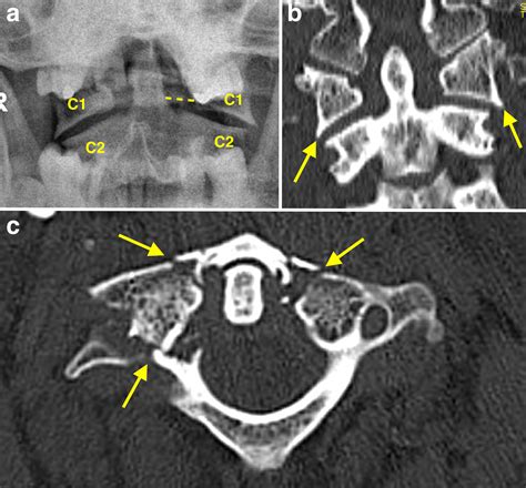 Jefferson fracture - Radiology at St. Vincent's University Hospital