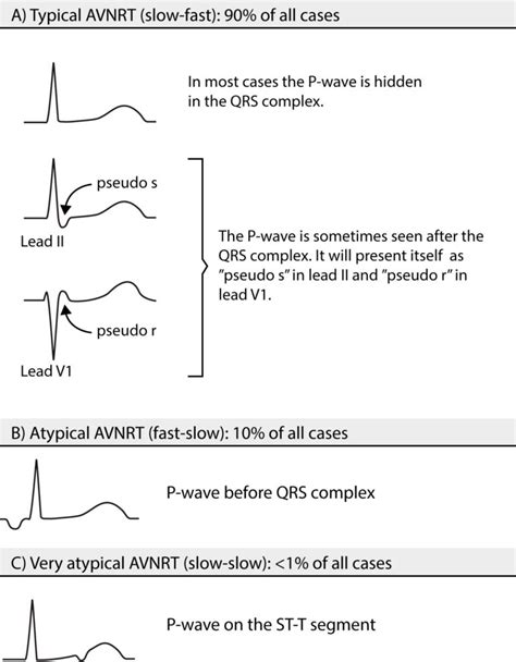 Atrioventricular nodal reentry tachycardia (AVNRT): ECG features & management – Cardiovascular ...