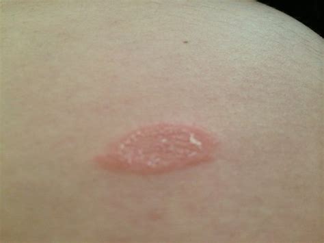 Red raised dry patches?? - BabyCenter