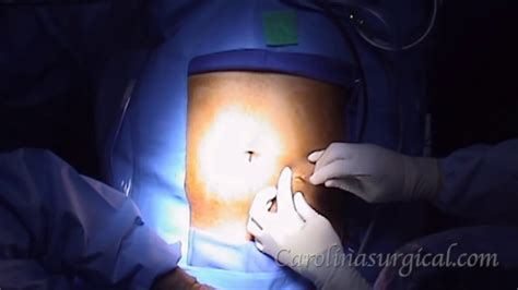 Appendicitis Surgery