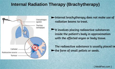 Internal Beam Radiation Therapy - All About Radiation