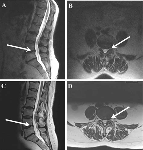 Positional difference of a disc herniation (L4/L5) from supine to ...