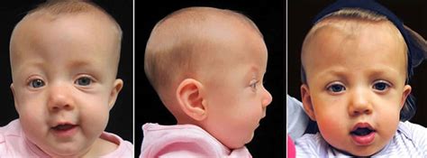 Craniosynostosis causes, symptoms, treatment & craniosynostosis surgery