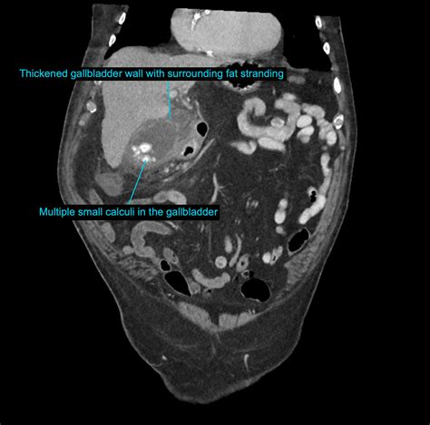 CT Case 059 • LITFL • CT scan interpretation