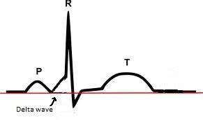 Sudden Cardiac Death - St. Louis Game Time