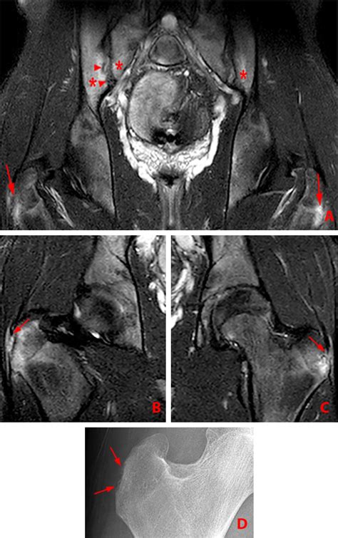 Ankylosing Spondylitis | Radsource