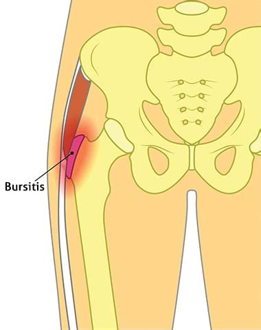 Trochanteric Hip Bursitis | Spine & Orthopedic Center