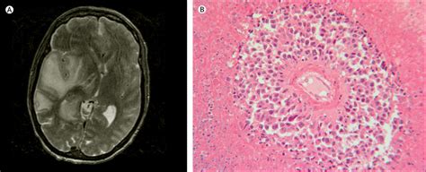 Leptomeningeal metastasis of classical Hodgkin lymphoma in a patient with malignant posterior ...