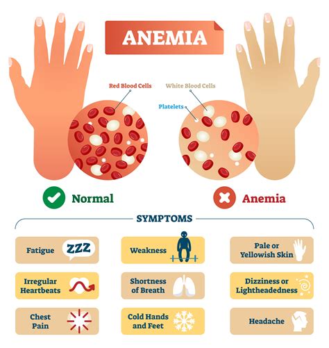 Iron-Deficiency Anemia - HealthScopeHealthScope