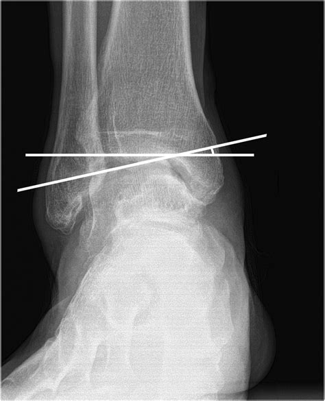 Relationship between talofibular impingement and increased talar tilt in incongruent varus ankle ...