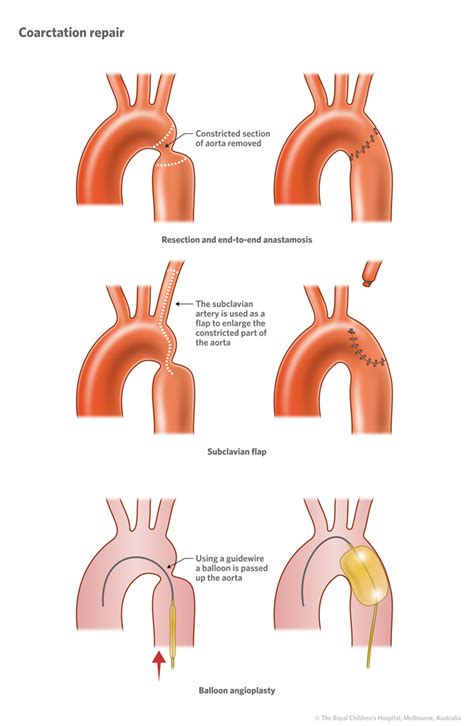 Cardiology : Coarctation of the Aorta HD