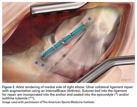 Ulnar Collateral Ligament Reconstruction Versus Repair With, 56% OFF