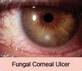 Mukherjee Eye Klinik :: Corneal Infection