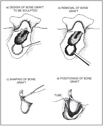 Cortical Mastoidectomy