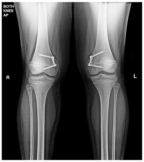 Knock Knees Treatment (Genu Valgum), Symptoms & Causes | Trishla Ortho