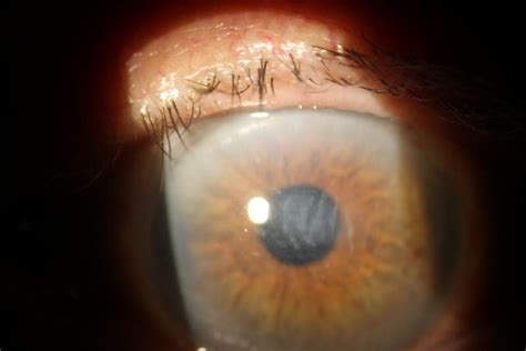 Corneal Edema After Cataract Surgery – Los Alamos Family Eyecare, P.C.