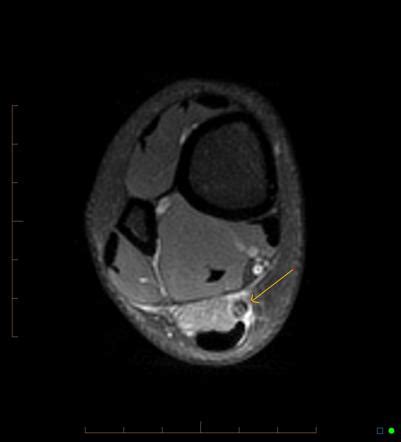 Plantaris Tendon Rupture Mri | SexiezPicz Web Porn