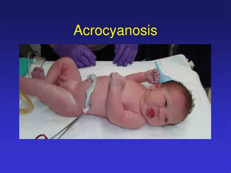 PPT - Cardiac Murmurs in the Newborn Infant PowerPoint Presentation - ID:829200