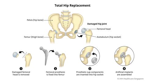 Hip Replacement Surgery | Gleneagles Hospital