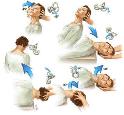 Physiotherapy treatment for vertigo (BPPV)