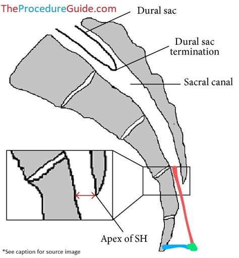 Fluoroscopic Guided Caudal Epidural Steroid Injection – Technique and Overview - The Procedure Guide