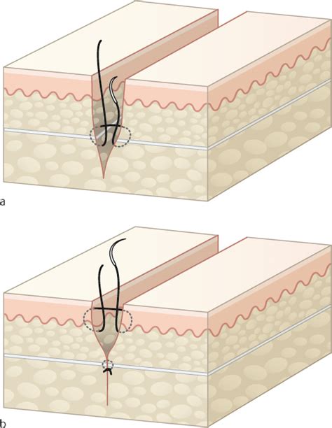 10 Wound closure and coverage techniques (I) | Musculoskeletal Key