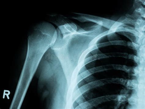 X-ray Image of Shoulder Fracture for a Medical Diagnosis Stock Photo - Image of move, break ...