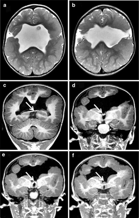 Schizencephaly causes, symptoms, diagnosis, treatment & prognosis