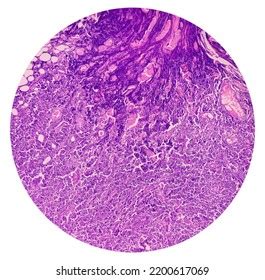 Supraclavicular Lymph Node Biopsy Microscopic Image Stock Photo 2200617069 | Shutterstock