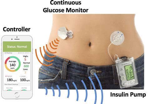 Artificial Pancreas System | Download Scientific Diagram