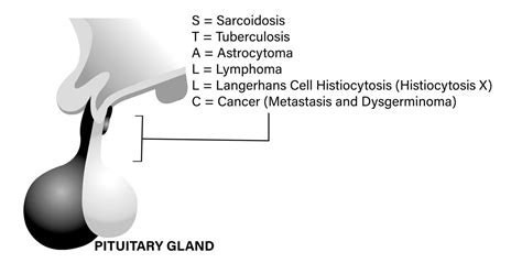 Pituitary Stalk Thickening - My Endo Consult