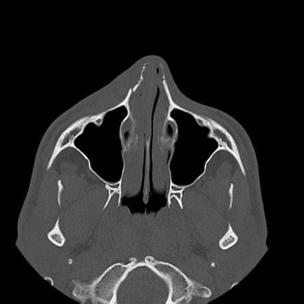 Frontal Process Of Maxilla Fracture