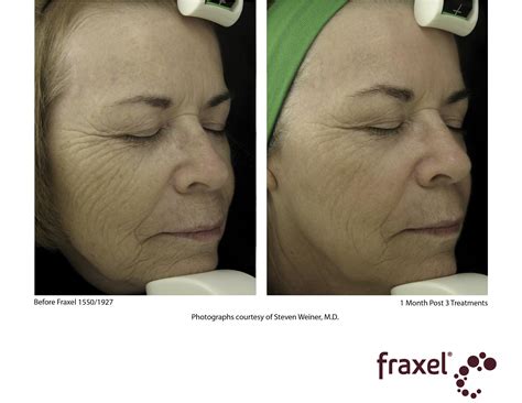 Fraxel Laser Treatment Bergen County, NJ | Queens and Long Island, NY