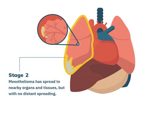 Stage 2 Mesothelioma | Treatment Options and Prognosis