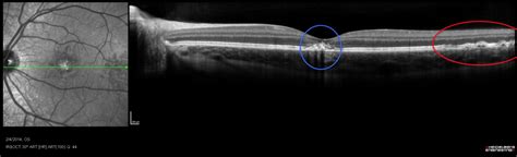 Eye Damage from Powerful Lasers Alarms Ophthalmologists | Columbia University Irving Medical Center