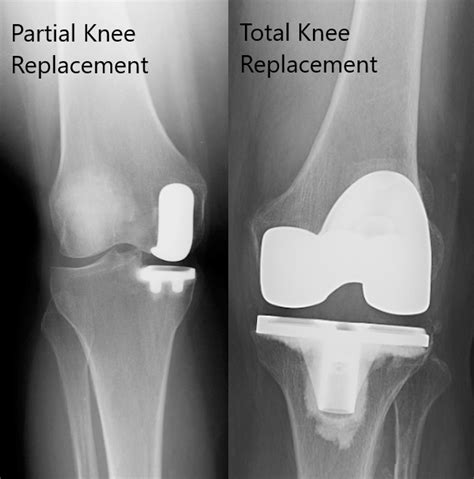 Knee Arthroplasty - Partial Versus Total • Paul N. Morton, MD