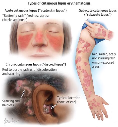 Cutaneous Lupus