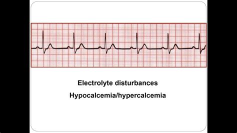 ECG Ion abnormalities Hypo hypercalcemia 2018 - YouTube