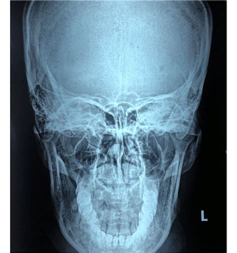 X-ray-Towne's view showing elongated styloid process | Download Scientific Diagram