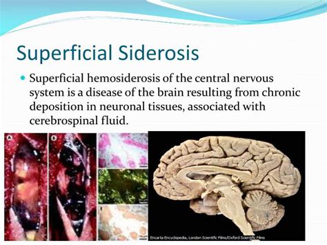 PPT - SIDEROSIS PowerPoint Presentation - ID:2029132