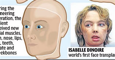 Patient well after radical full face transplant - Mirror Online