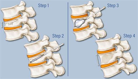 Kyphoplasty: Restore Spinal Health | Aptiva Health