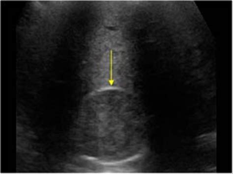 Abdomen and retroperitoneum | 1.10 Adrenal glands : Case 1.10.3 ...